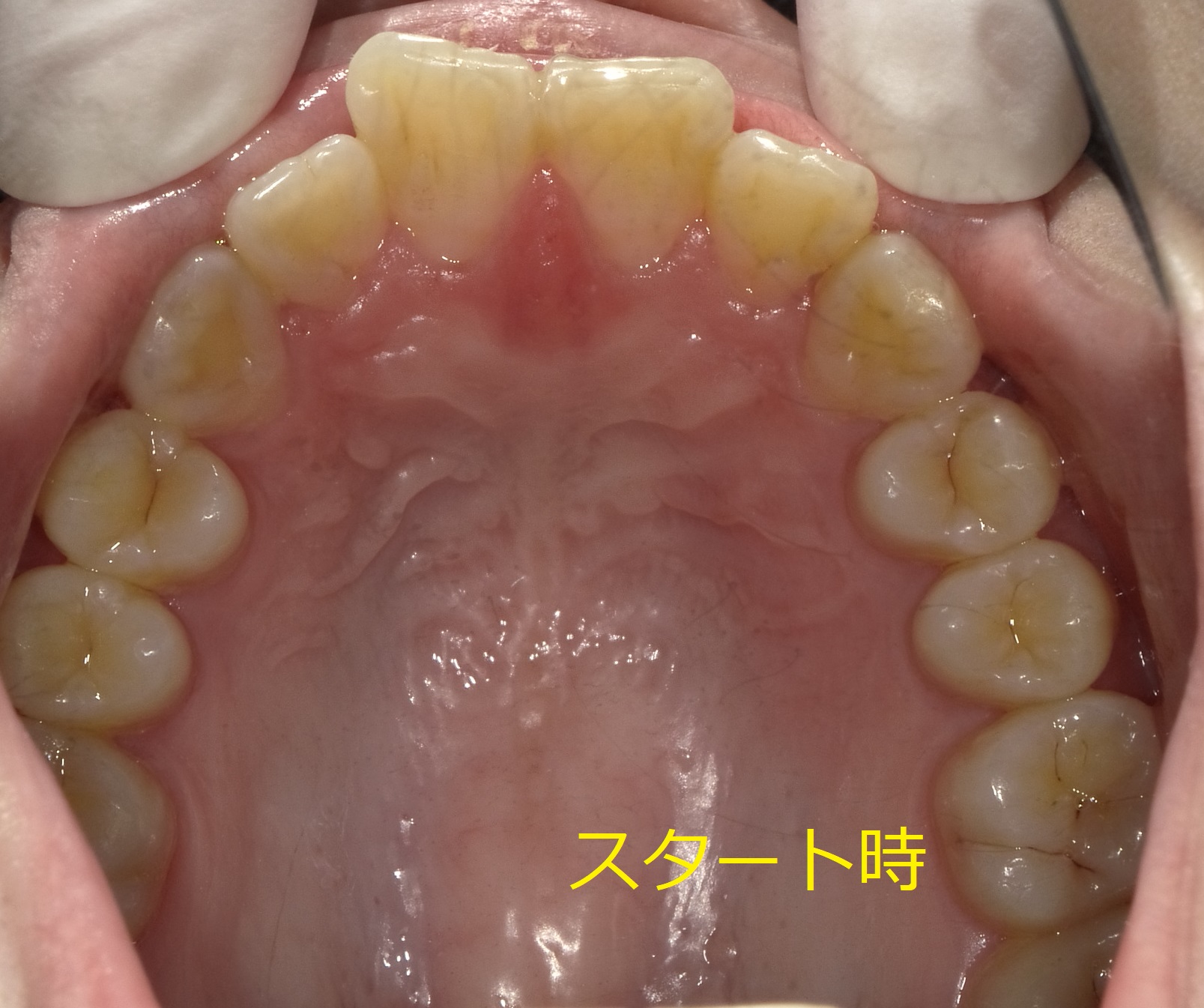 三ヶ月後に結婚式を控えた前歯の段差の症例。①