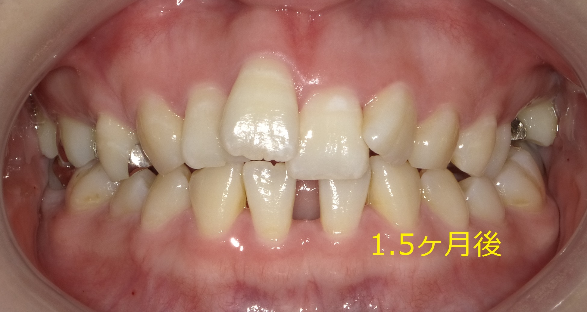 上顎のみ＋欠損スペースを利用しての矯正　⑤