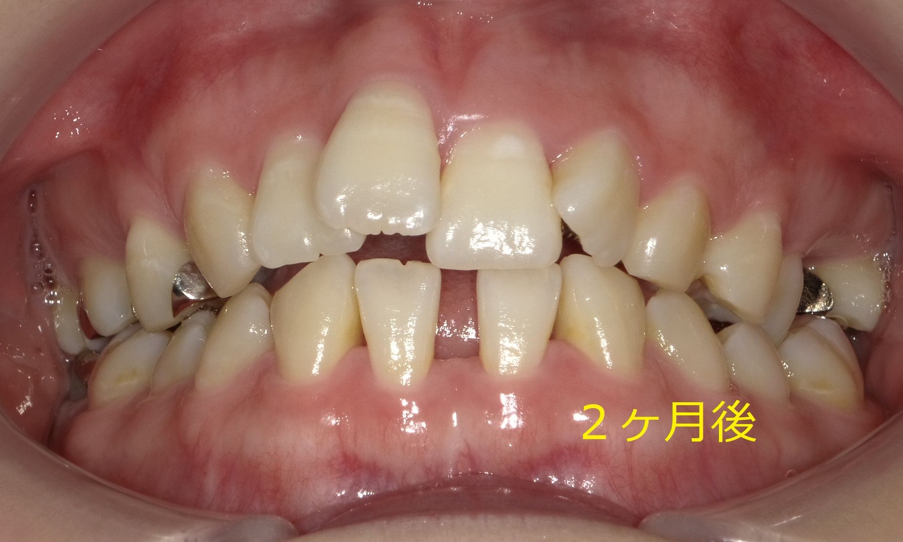 上顎のみ＋欠損スペースを利用しての矯正　⑥