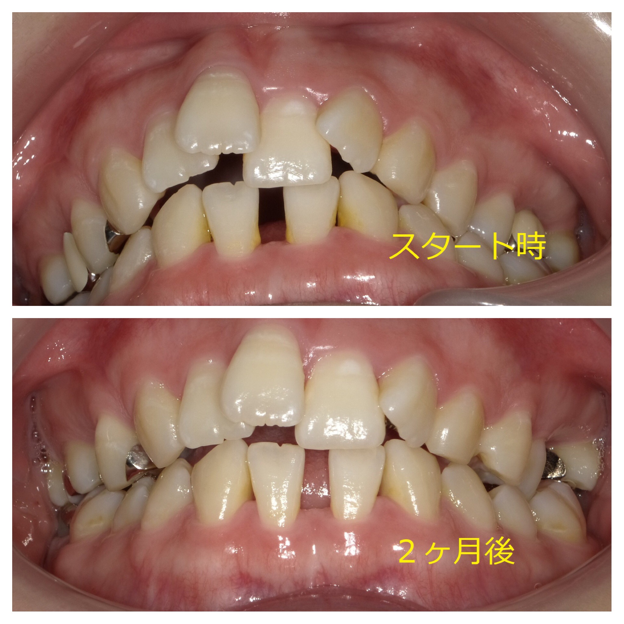 上顎のみ＋欠損スペースを利用しての矯正　⑥
