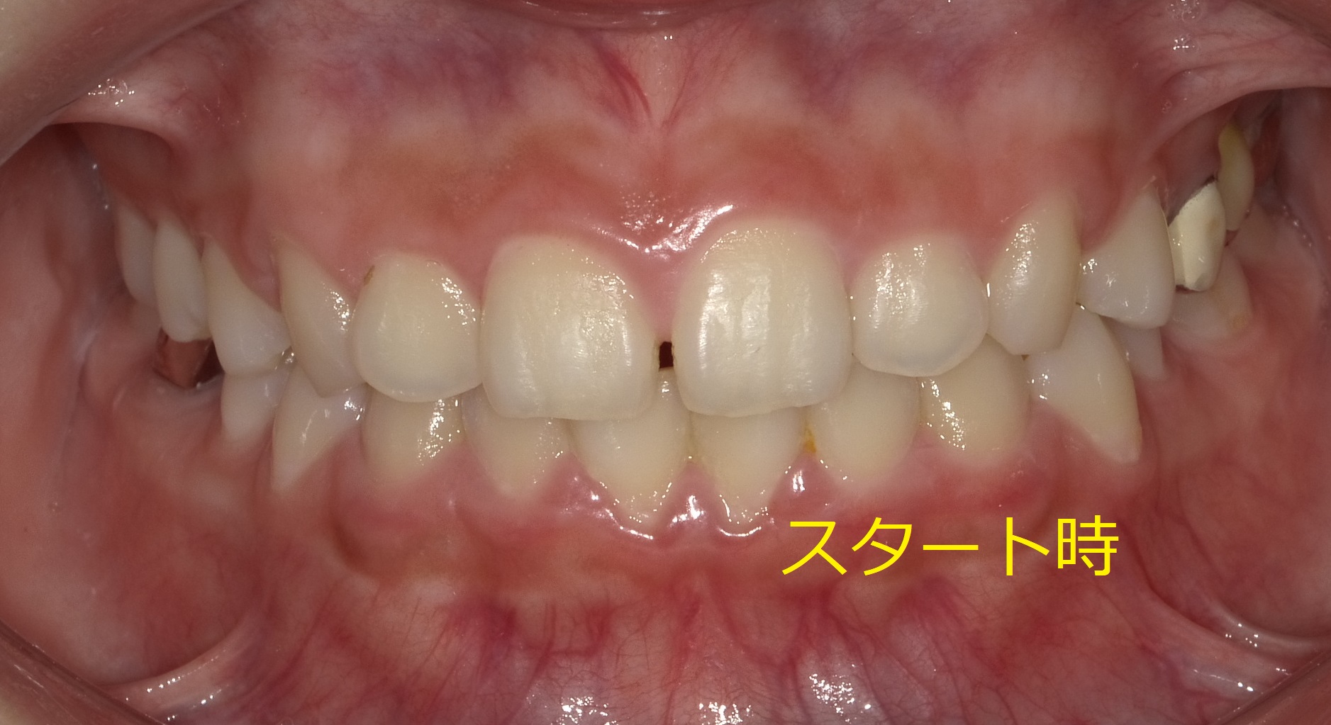 前歯の間に隙間がある症例　①