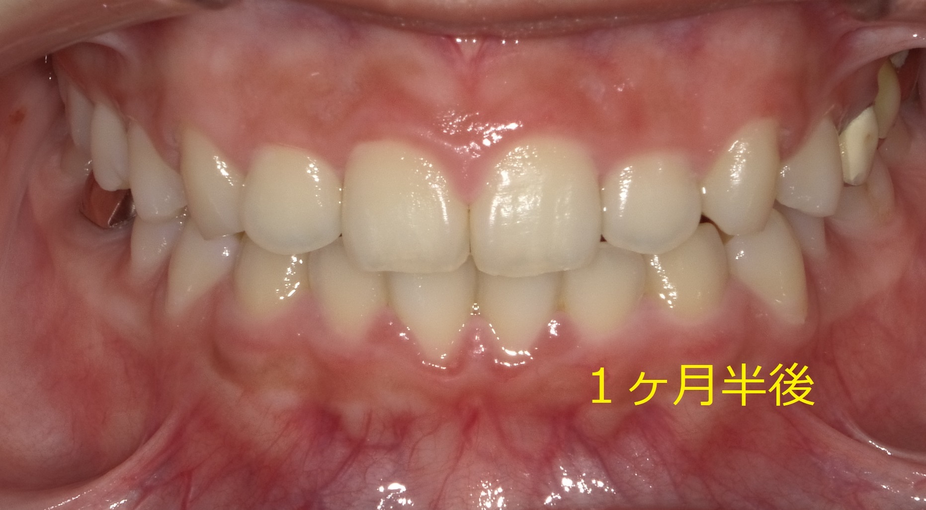 前歯の間に隙間がある症例　④