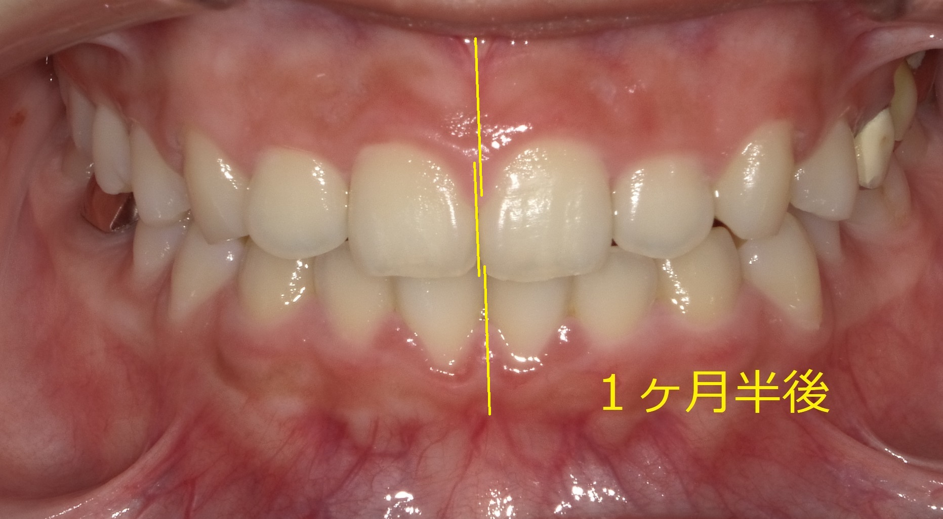 前歯の間に隙間がある症例　④