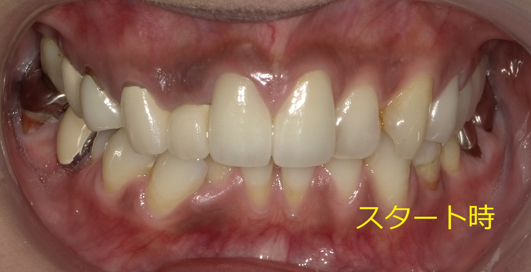 出っ歯をセラミックで治した症例。　①