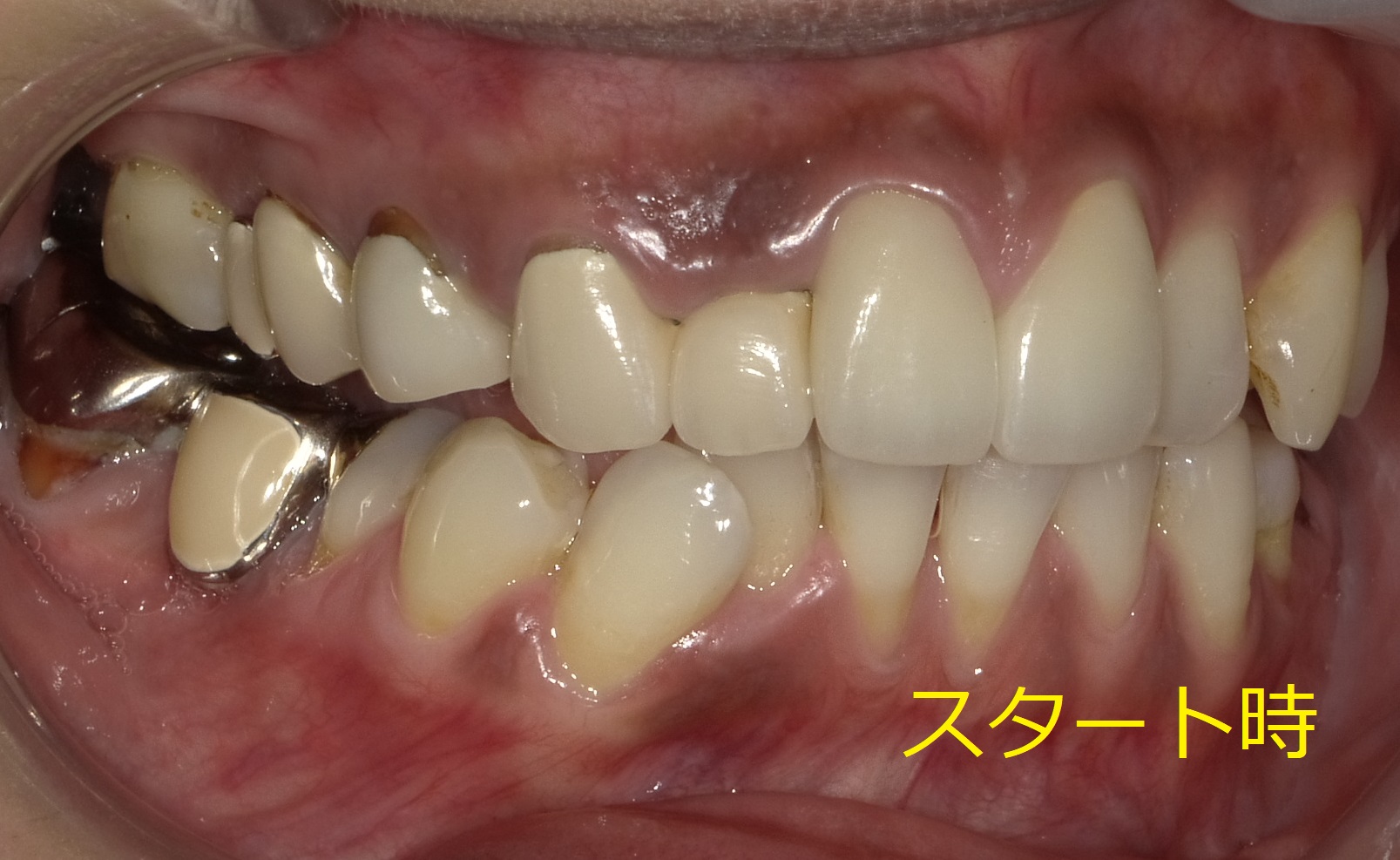 出っ歯をセラミックで治した症例。　②