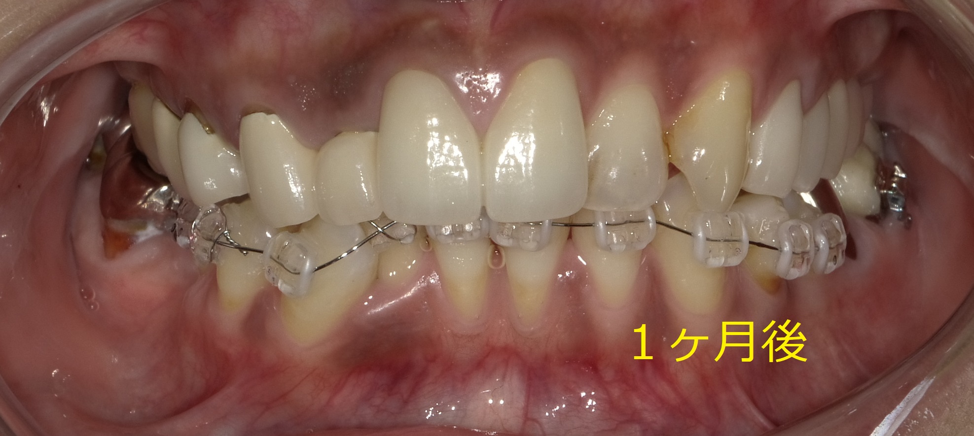 出っ歯をセラミックで治した症例。　④