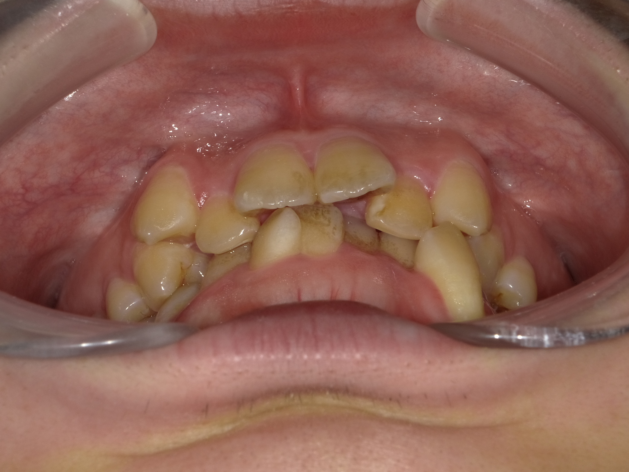 乱ぐい歯　叢生がキツイ症例。　①