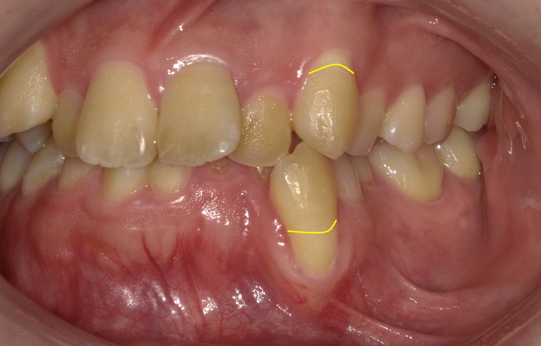  乱ぐい歯　叢生がキツイ症例。　③