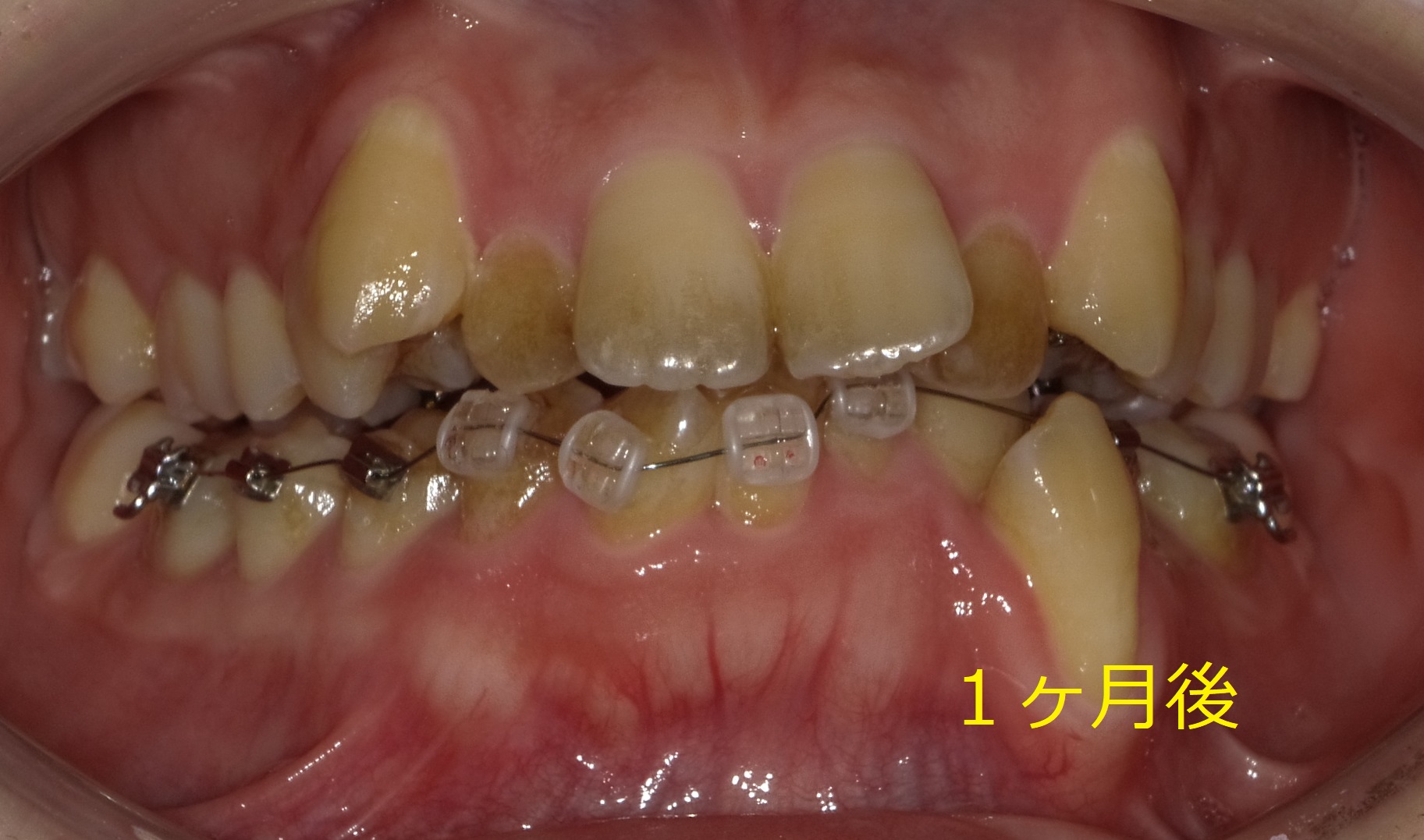 乱ぐい歯　叢生がキツイ症例。　⑤