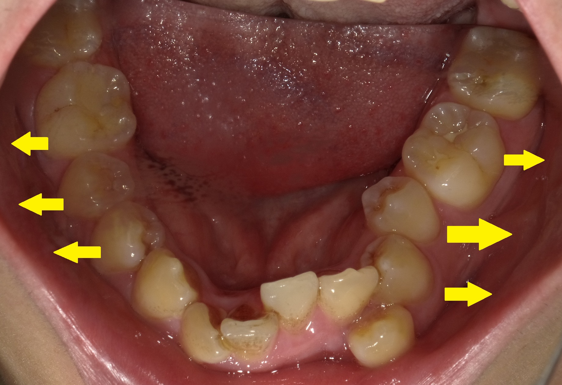乱ぐい歯　叢生がキツイ症例。　⑤