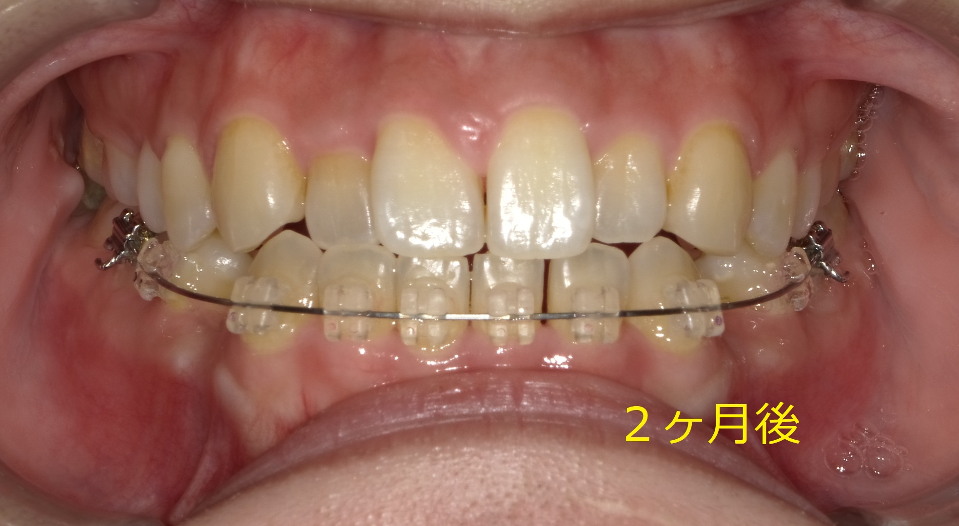 上顎が小さく、前歯が一本交差している症例　④