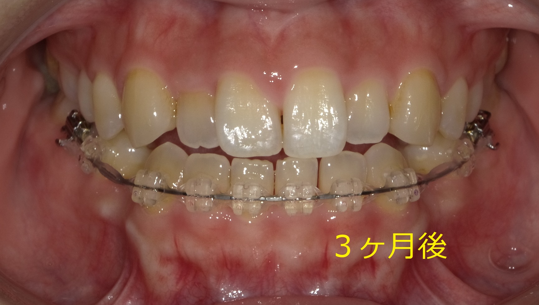 上顎が小さく、前歯が一本交差している症例　⑤