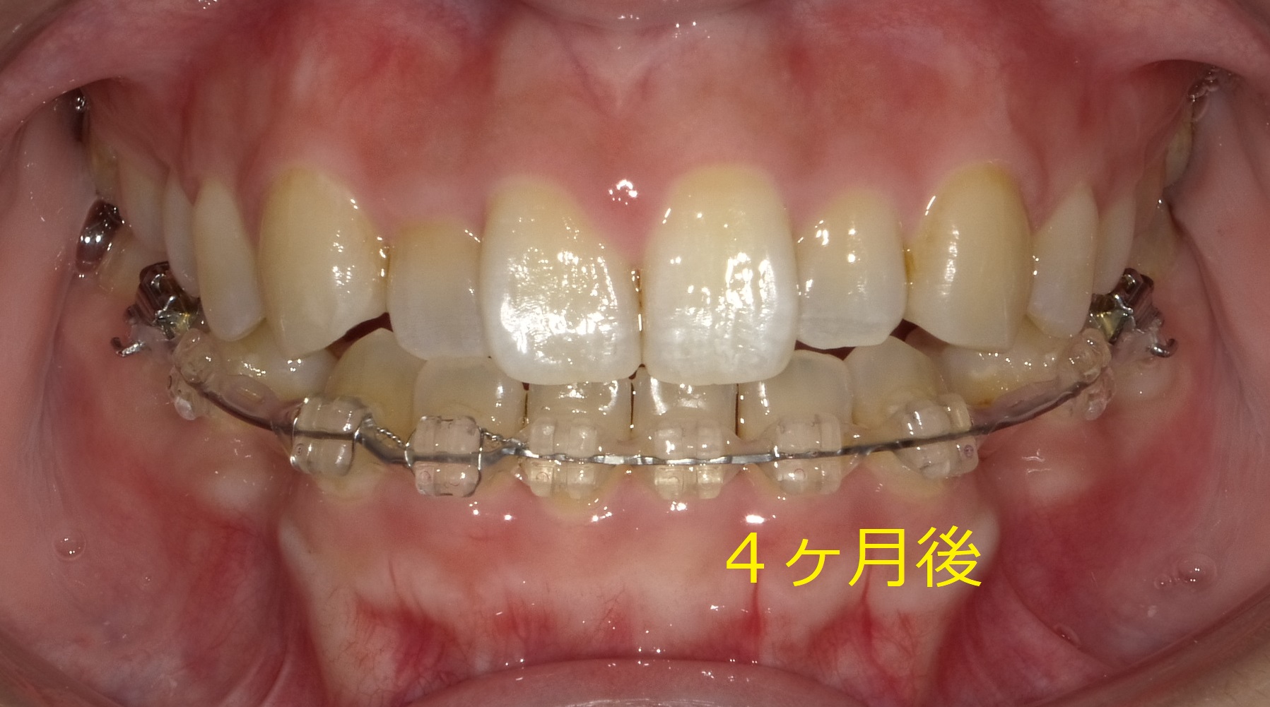 上顎が小さく、前歯が一本交差している症例　⑥