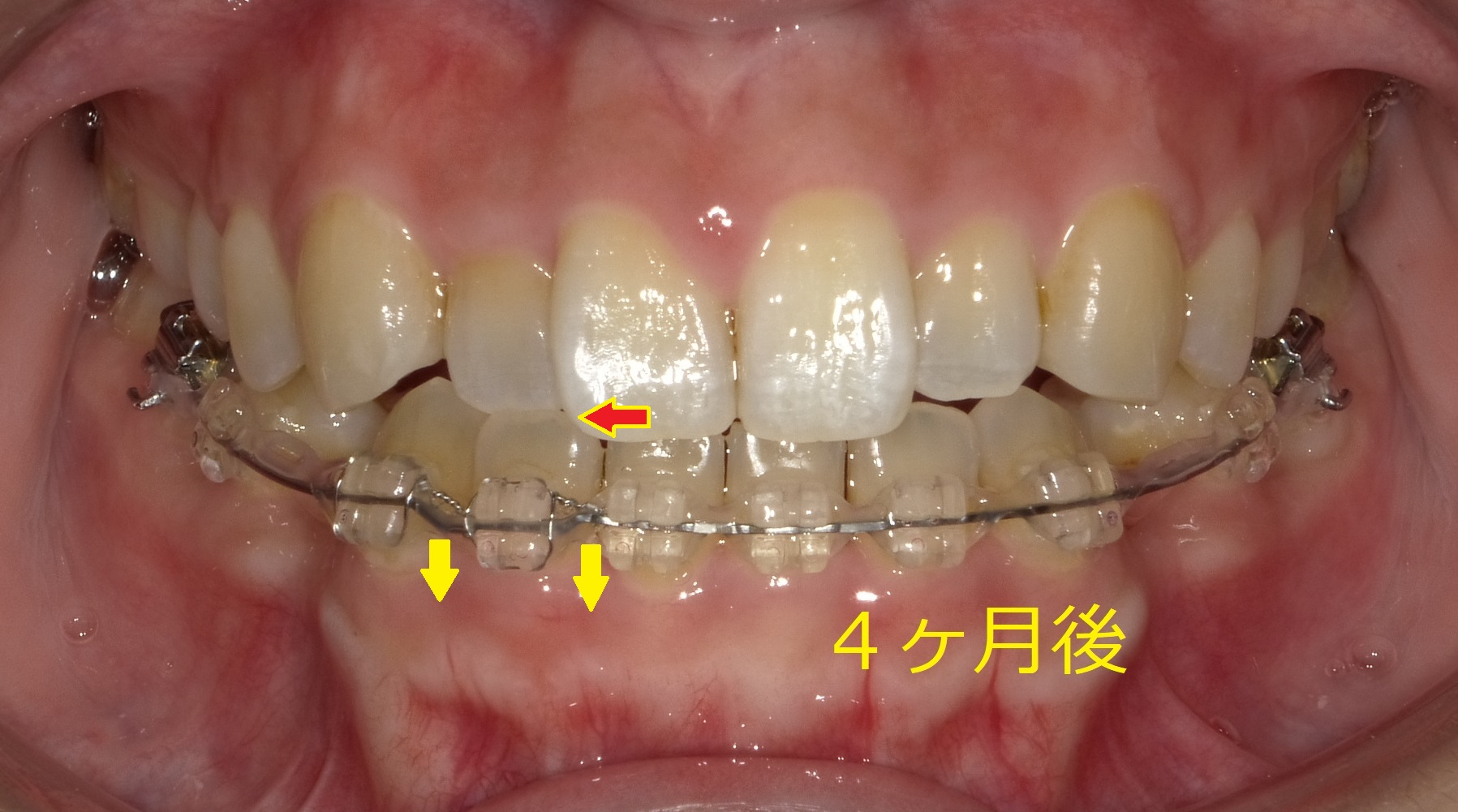 上顎が小さく、前歯が一本交差している症例　⑥