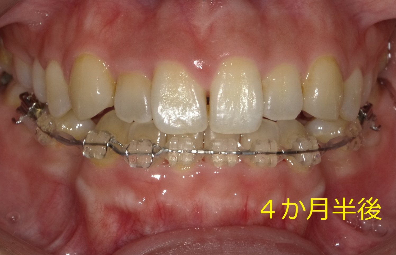 上顎が小さく、前歯が一本交差している症例　⑦