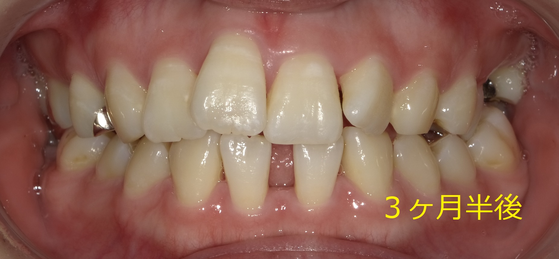 上顎のみ＋欠損スペースを利用しての矯正　⑦