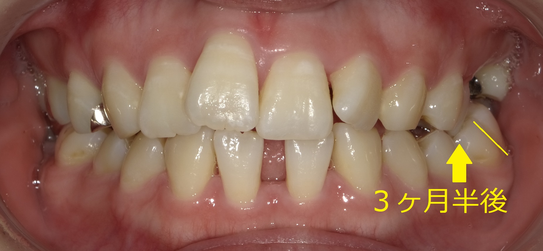 上顎のみ＋欠損スペースを利用しての矯正　⑦