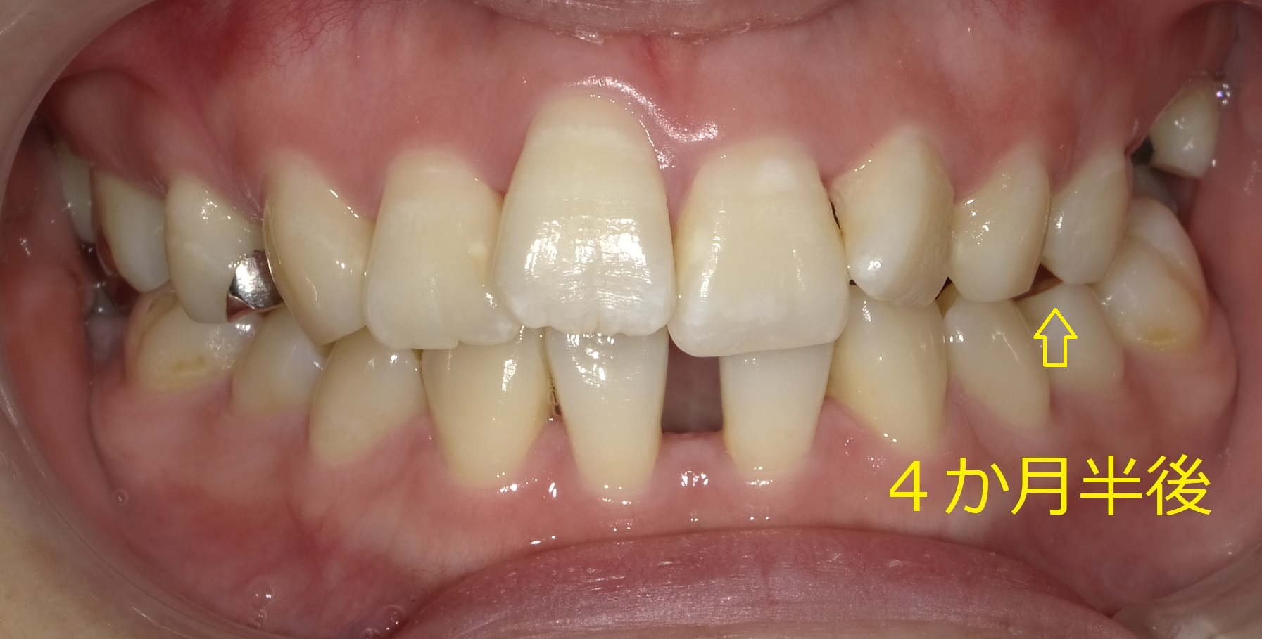 上顎のみ＋欠損スペースを利用しての矯正　⑧