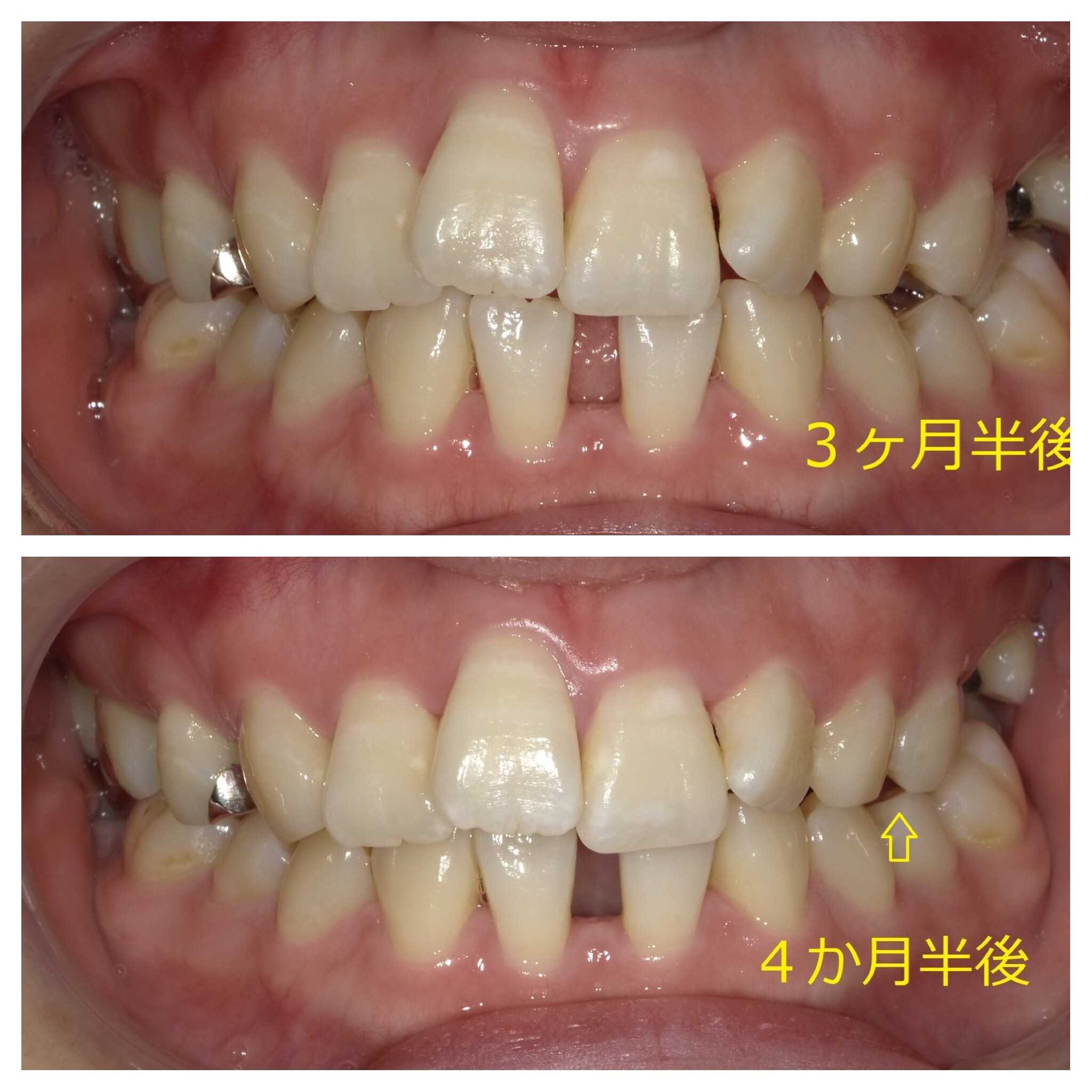 上顎のみ＋欠損スペースを利用しての矯正　⑧