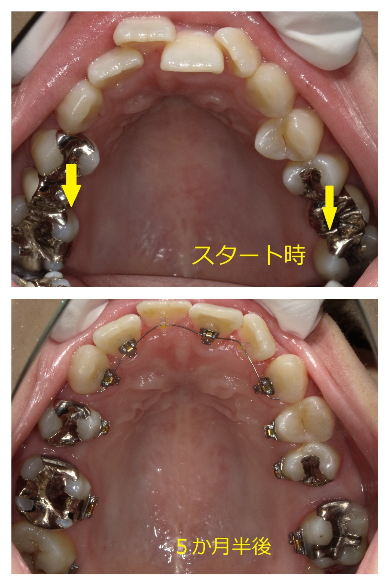 上顎のみ＋欠損スペースを利用しての矯正　⑨