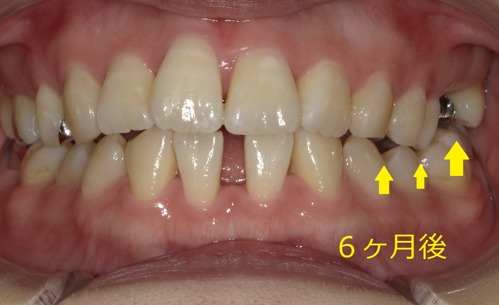 上顎のみ＋欠損スペースを利用しての矯正　⑩