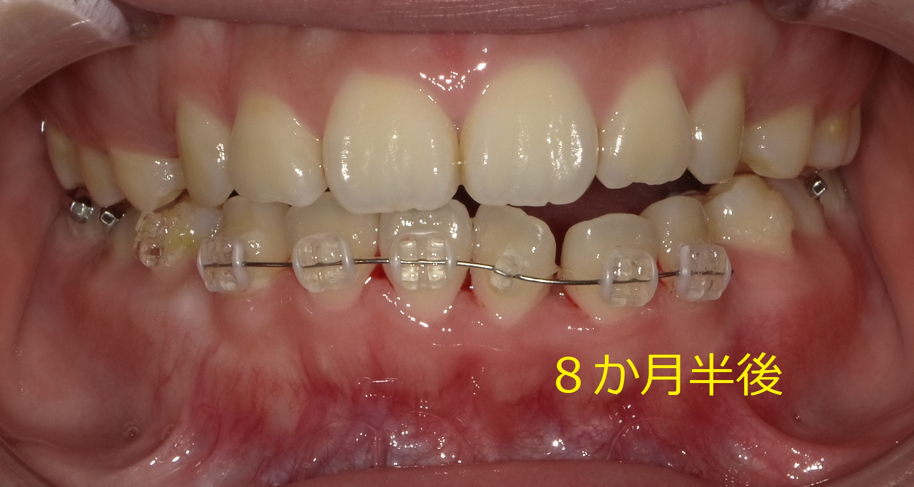 開口（オープンバイト）　⑧