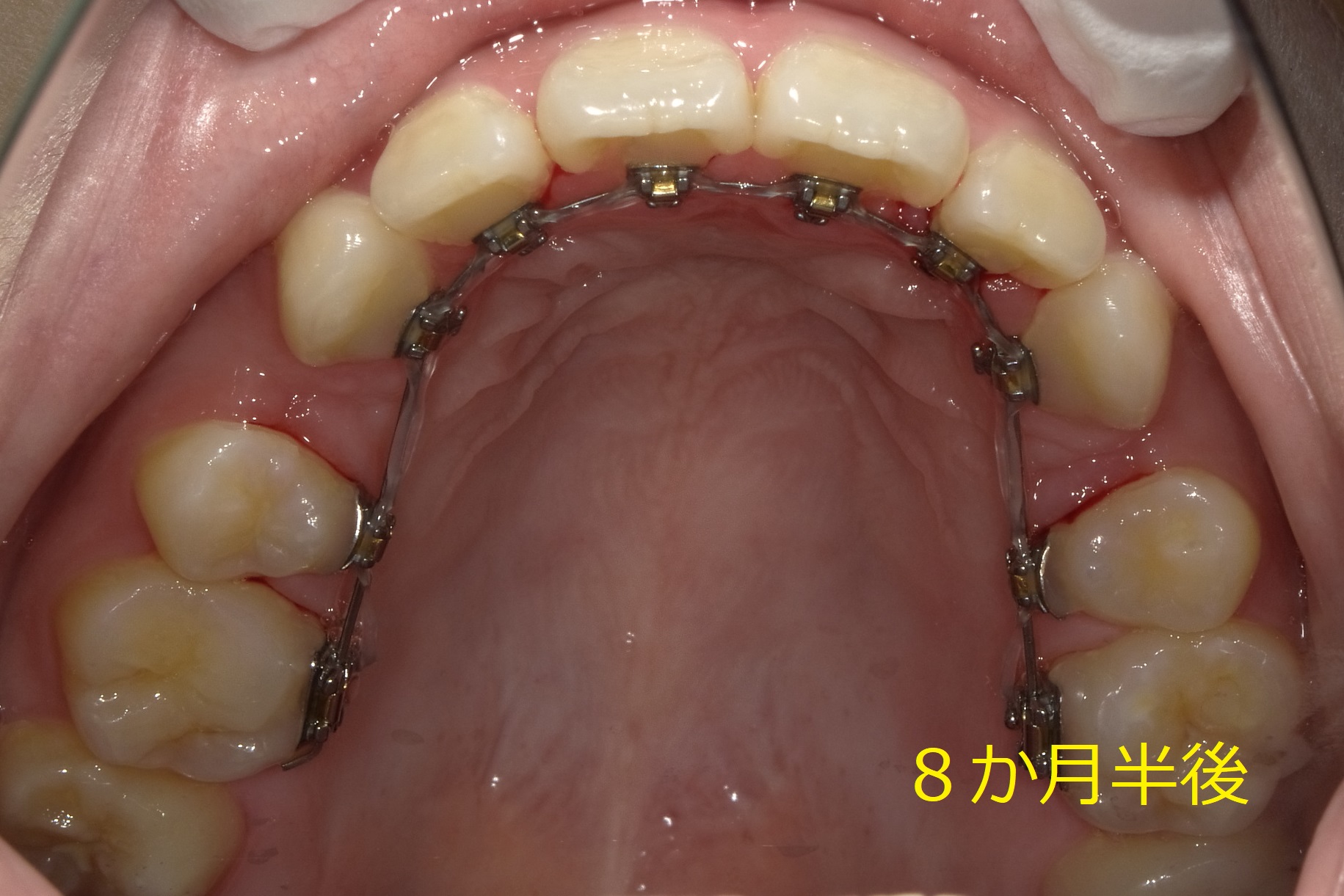 開口（オープンバイト）　⑧