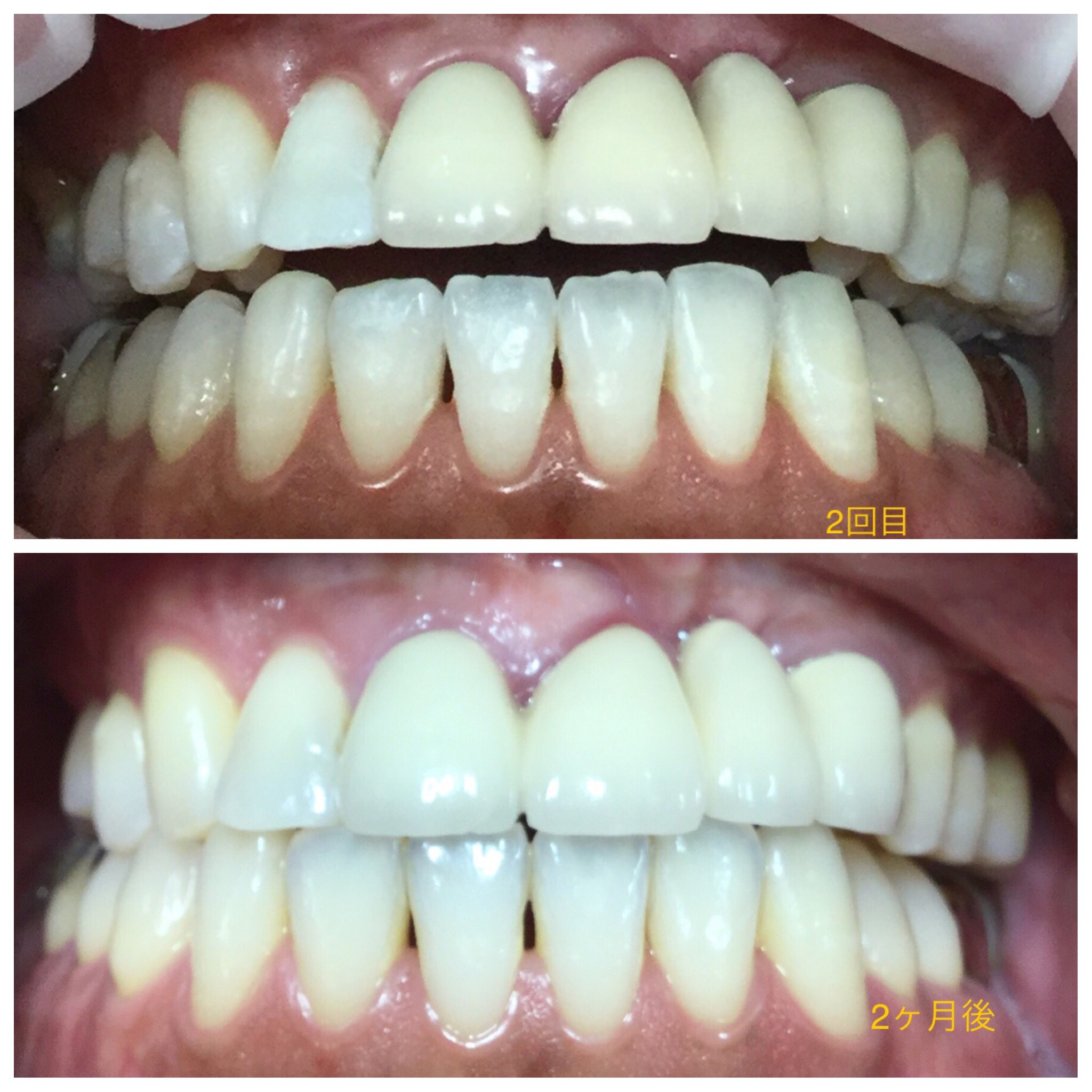 ホワイトニング持続検証３０代1-3