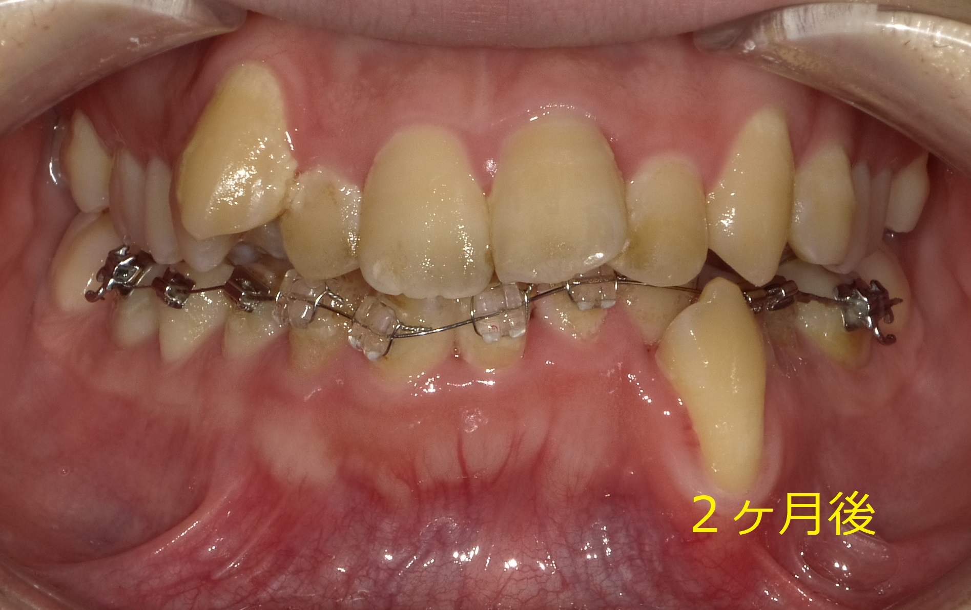 乱ぐい歯　叢生がキツイ症例。　⑥