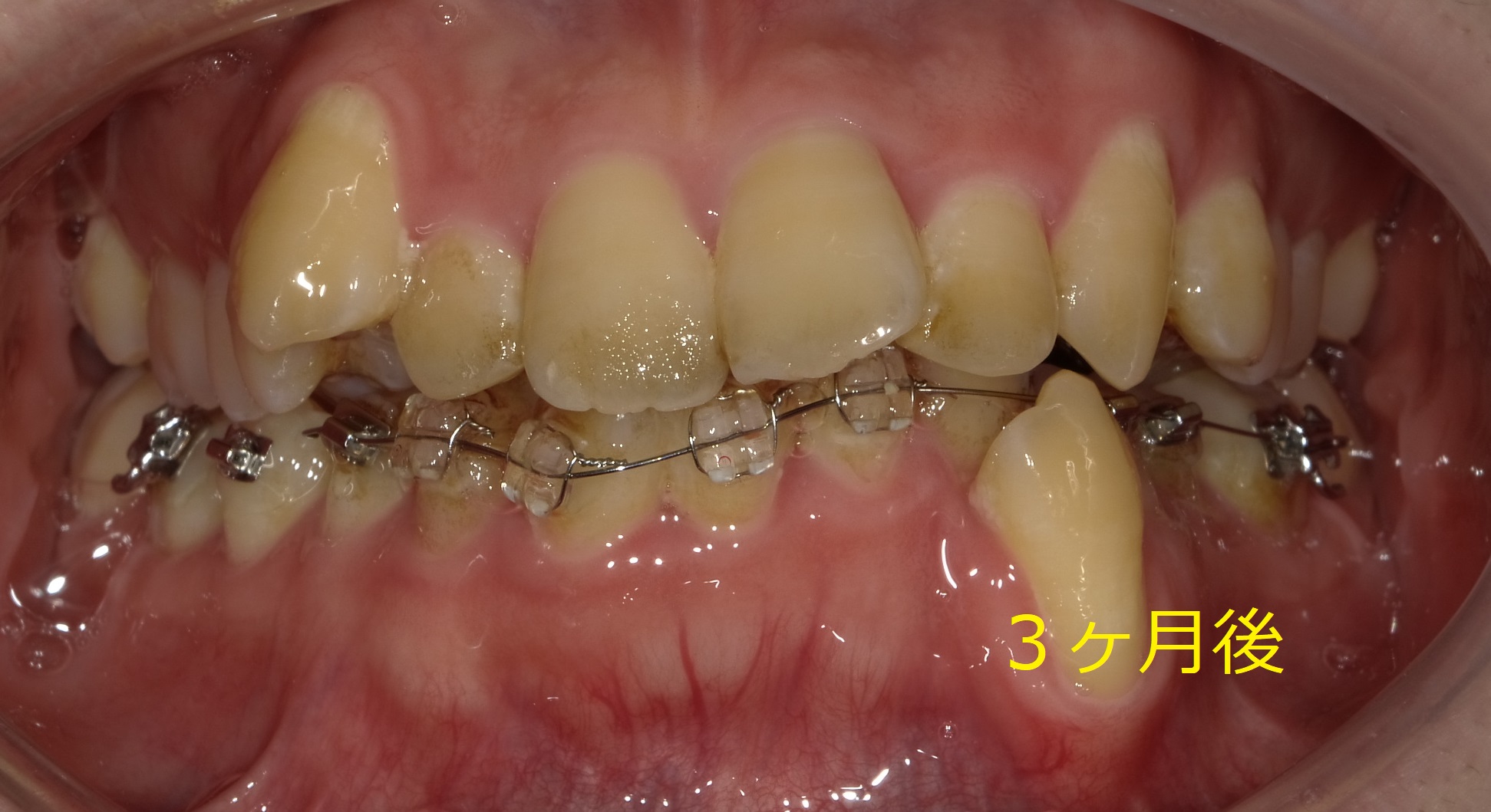 乱ぐい歯　叢生がキツイ症例。　⑦