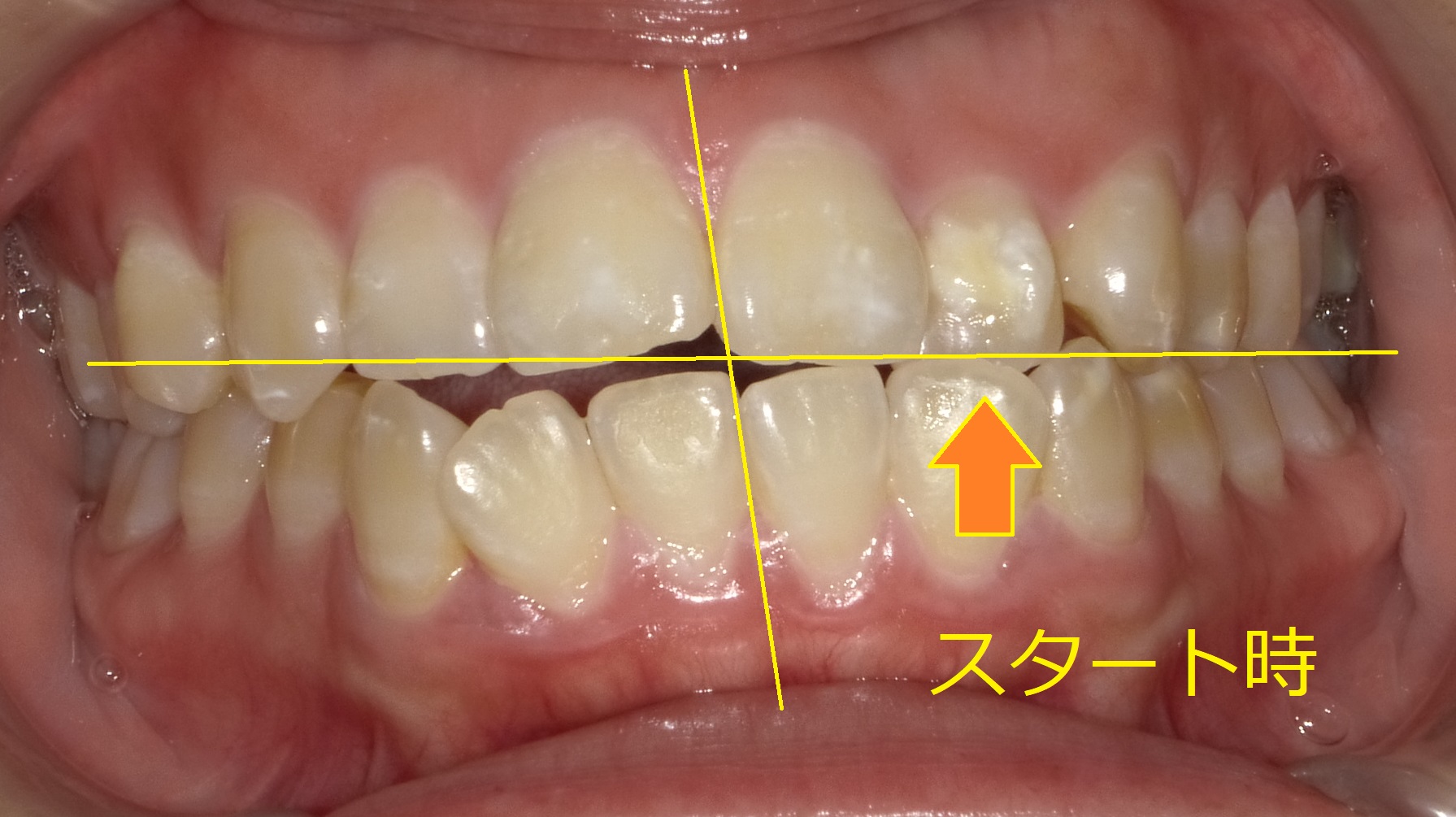 上顎が小さく、受け口っぽくみえる症例Ⅱ　①