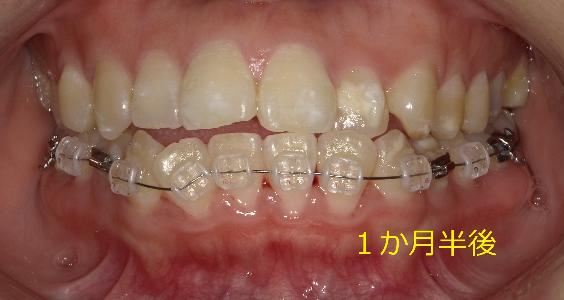 上顎が小さく、受け口っぽくみえる症例Ⅱ　②