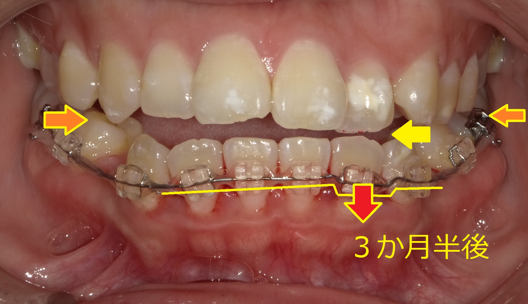 上顎が小さく、受け口っぽくみえる症例Ⅱ　④