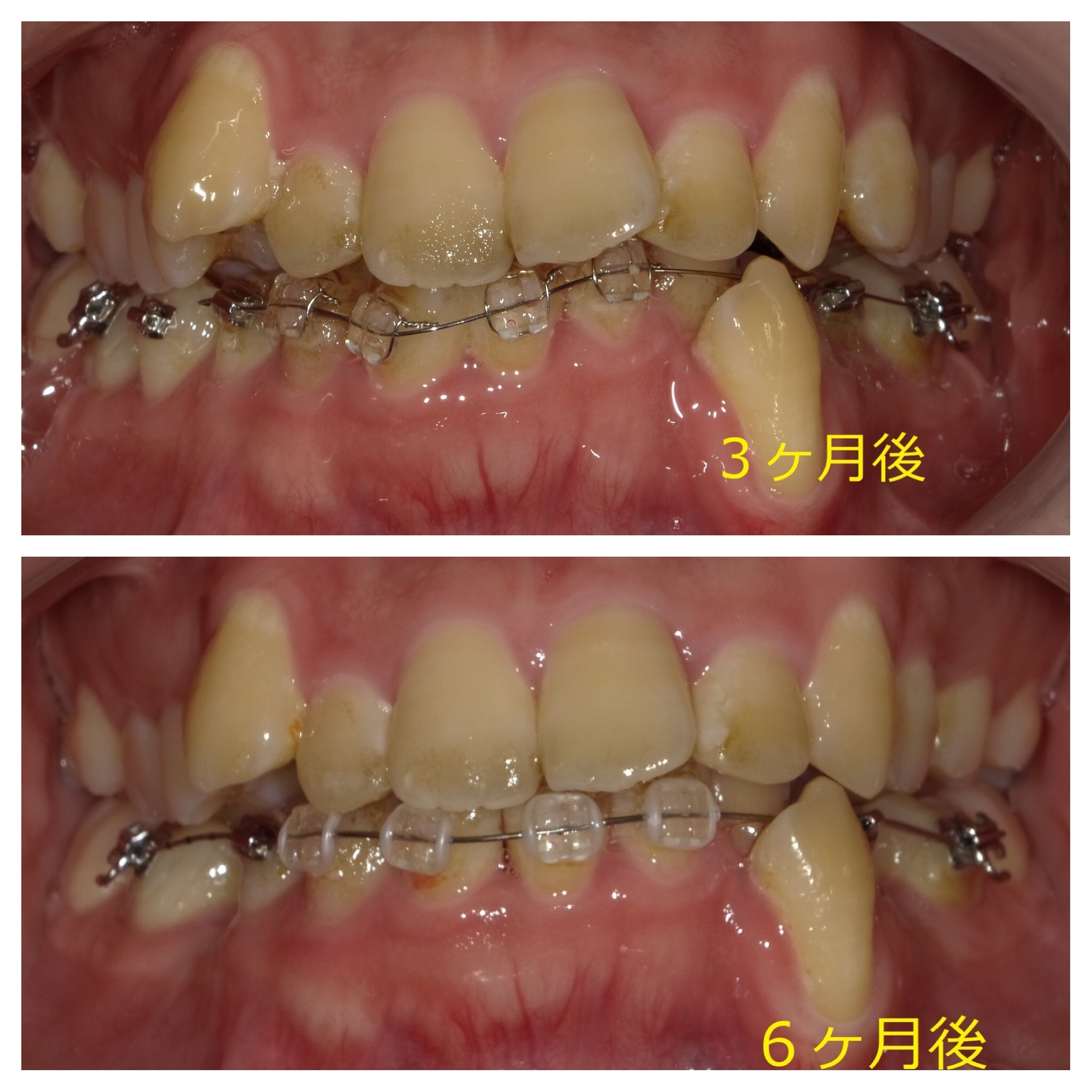 乱ぐい歯　叢生がキツイ症例。　⑧