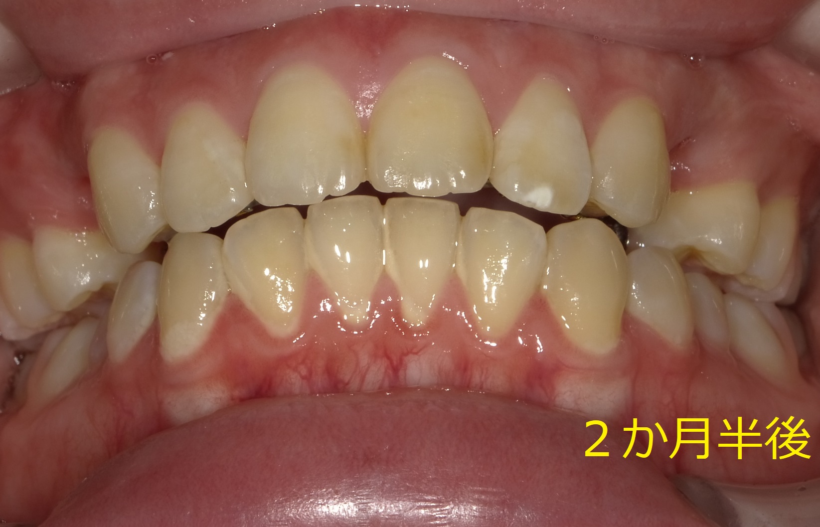  上顎のみの全体矯正。～出っ歯の改善Ⅱ～　②