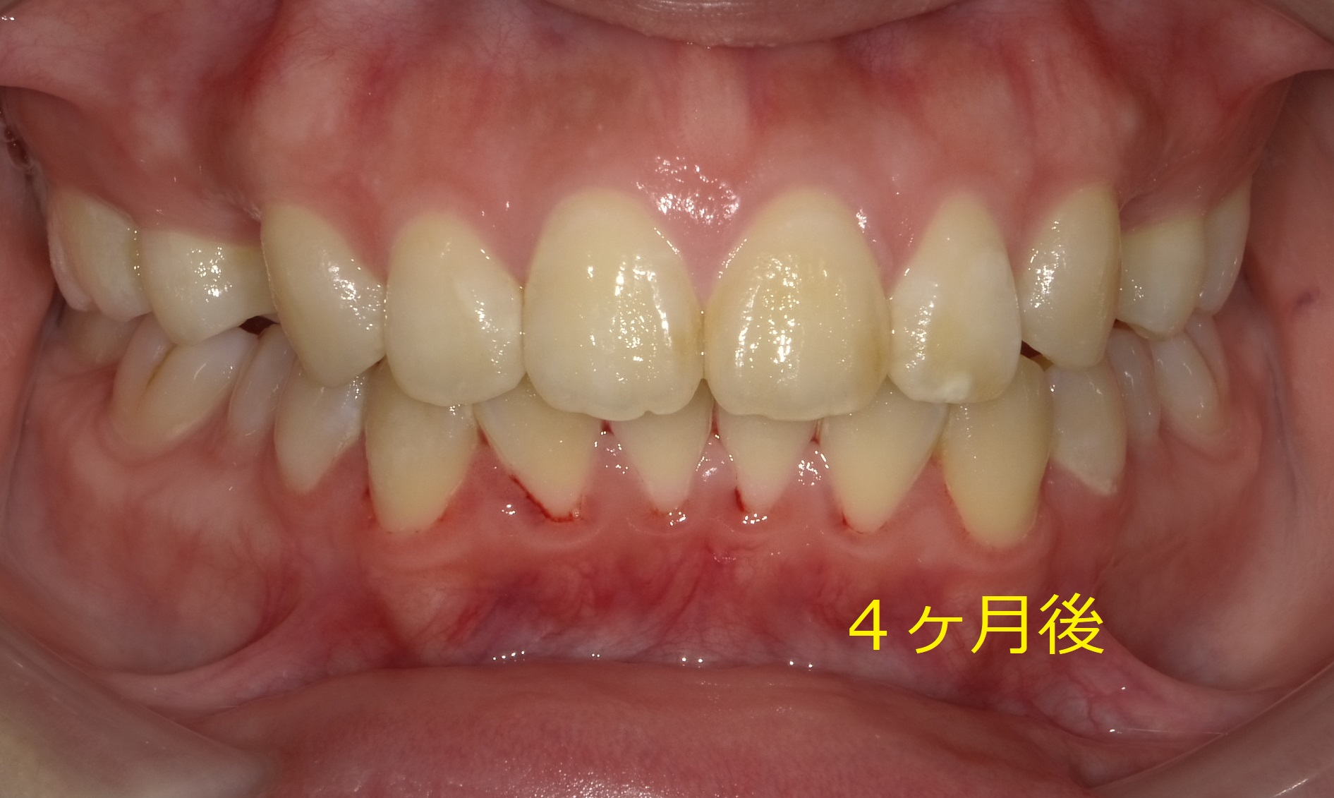  上顎のみの全体矯正。～出っ歯の改善Ⅱ～　③