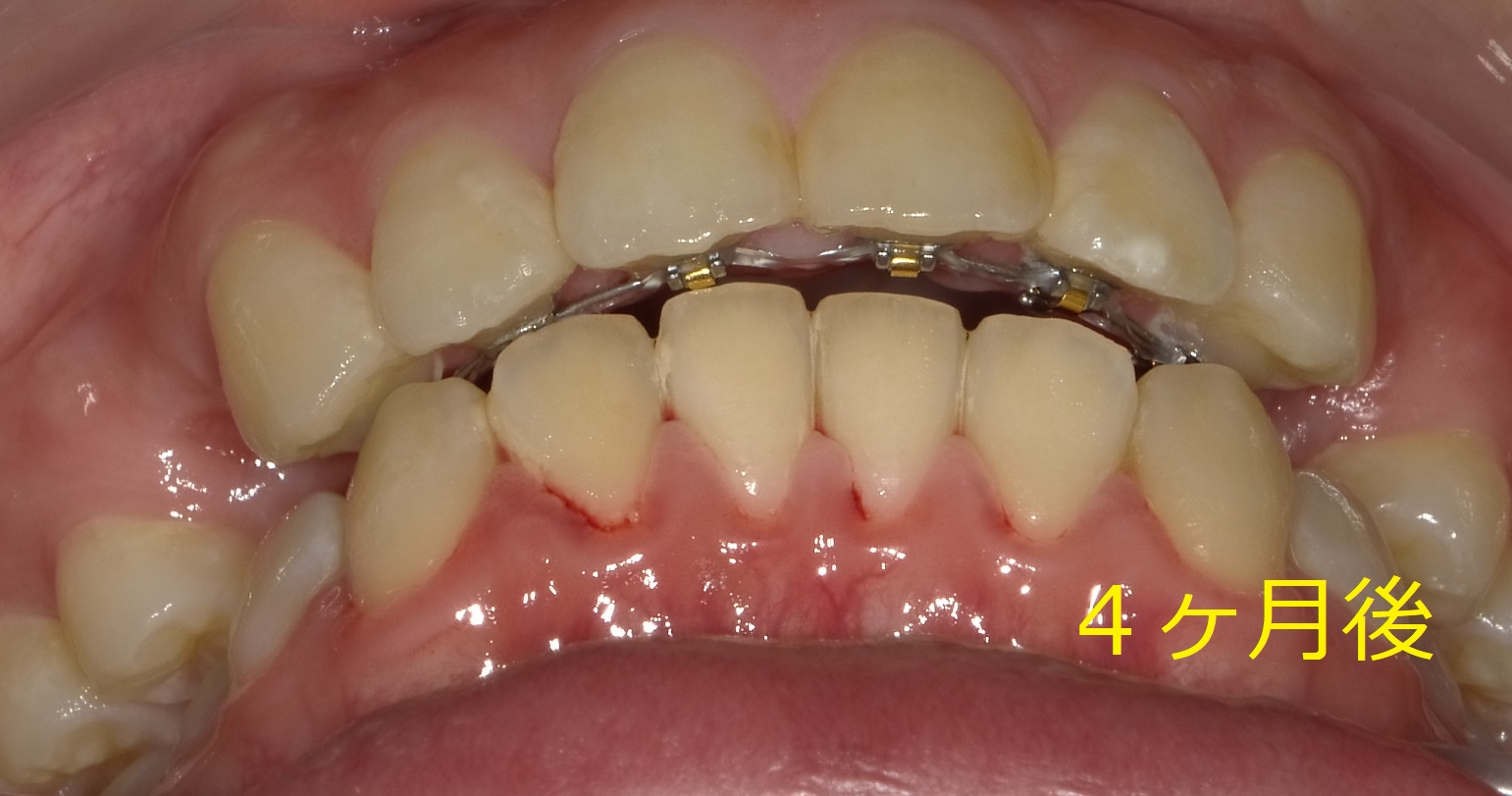  上顎のみの全体矯正。～出っ歯の改善Ⅱ～　③