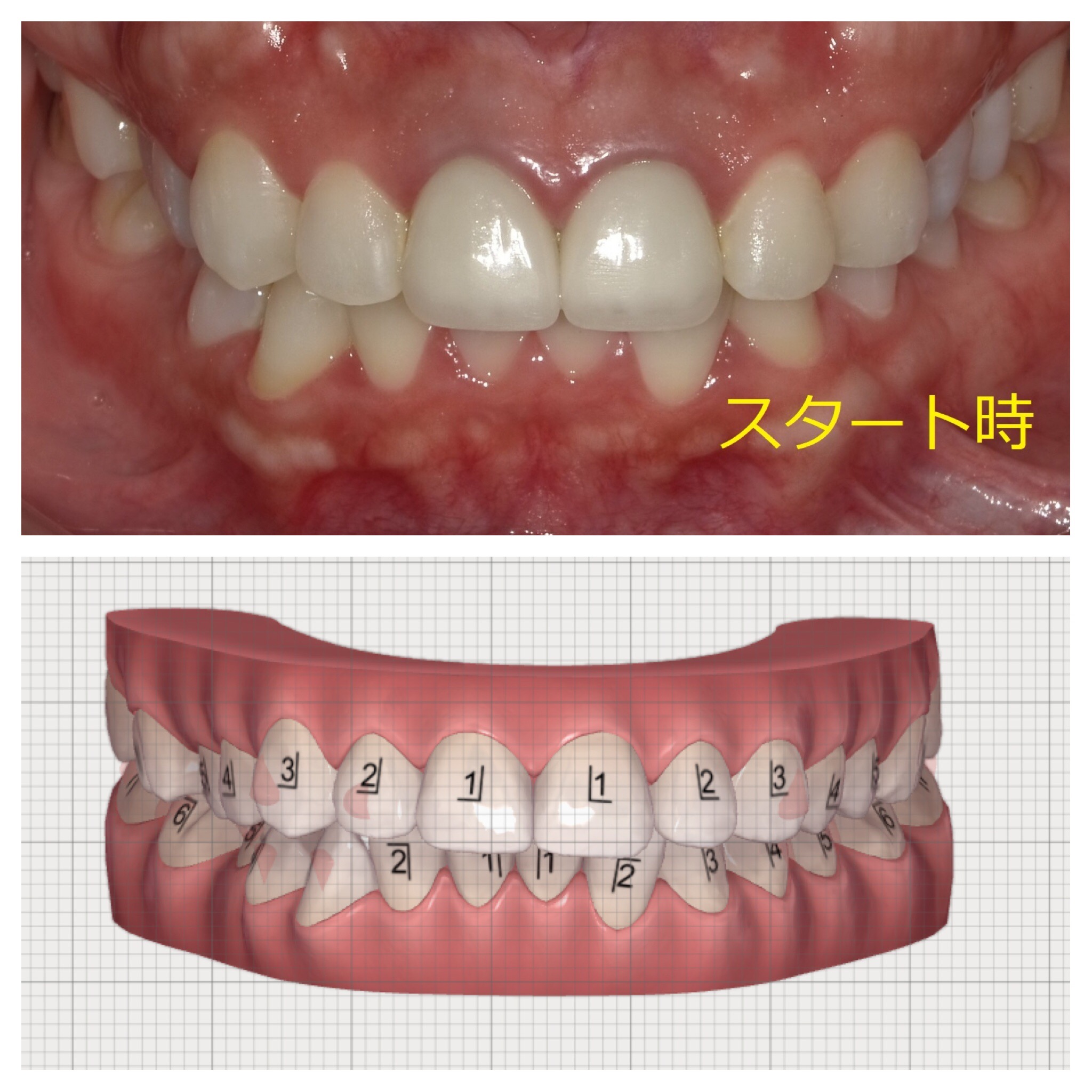 インビザラインによる上下部分矯正　⑤