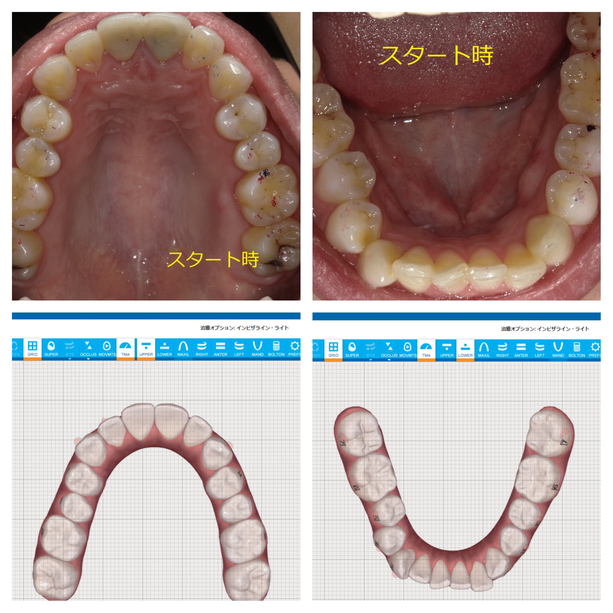 インビザラインによる上下部分矯正　⑤