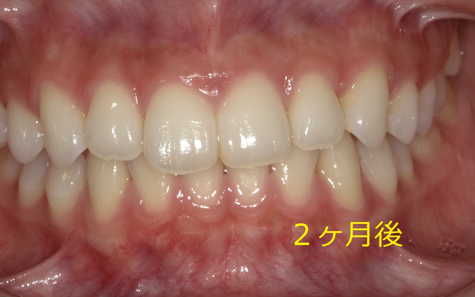 １回のみのマウスピース矯正（クリアアライナー）　③