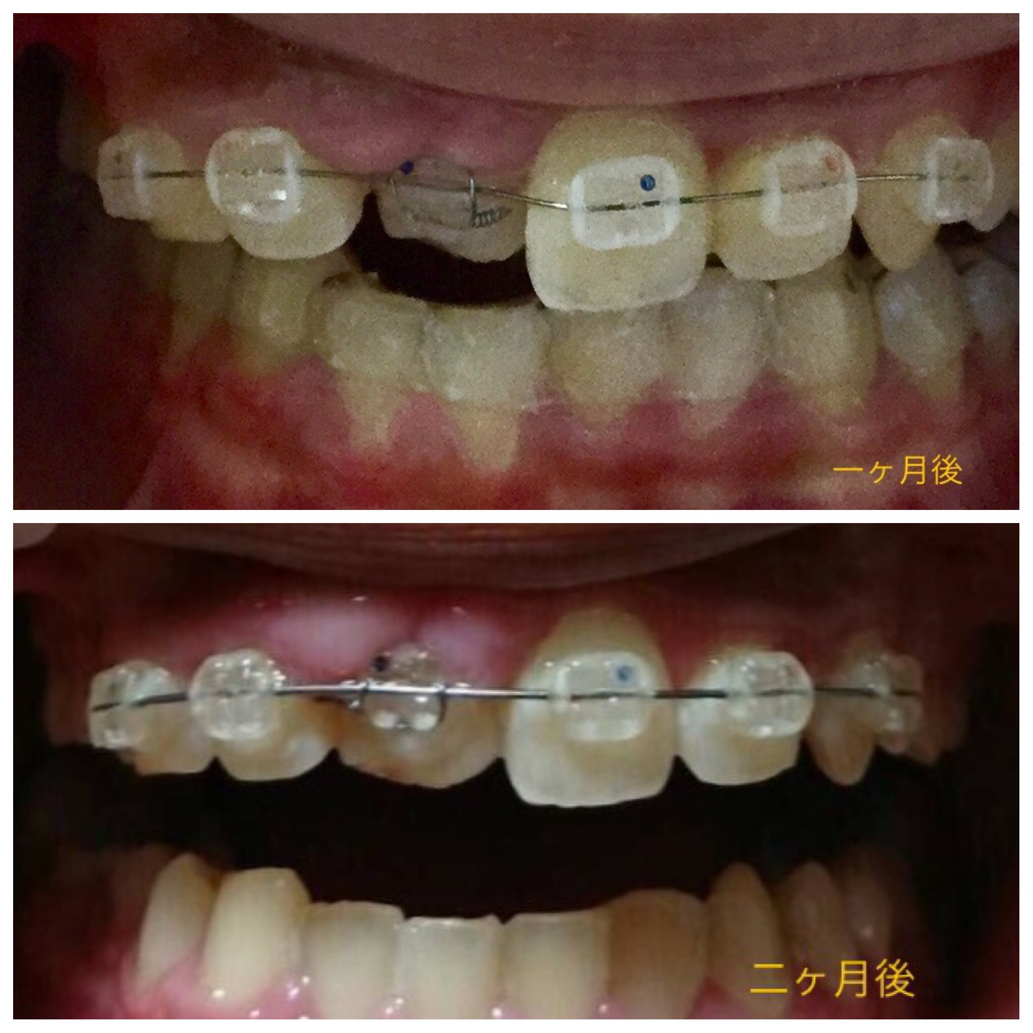 前歯が一本だけ入り込んだ症例（２ヶ月後）