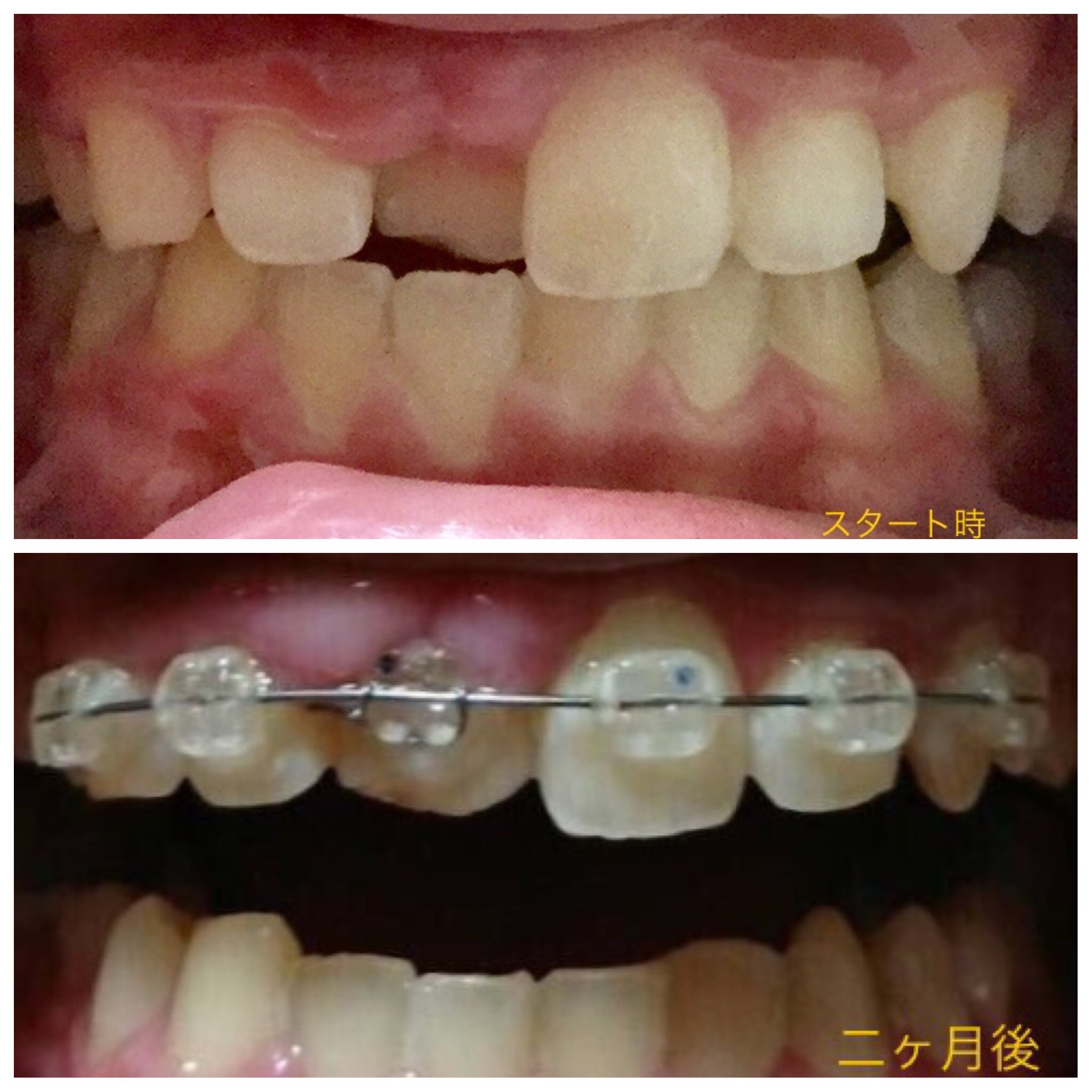 前歯が一本だけ入り込んだ症例（２ヶ月後）