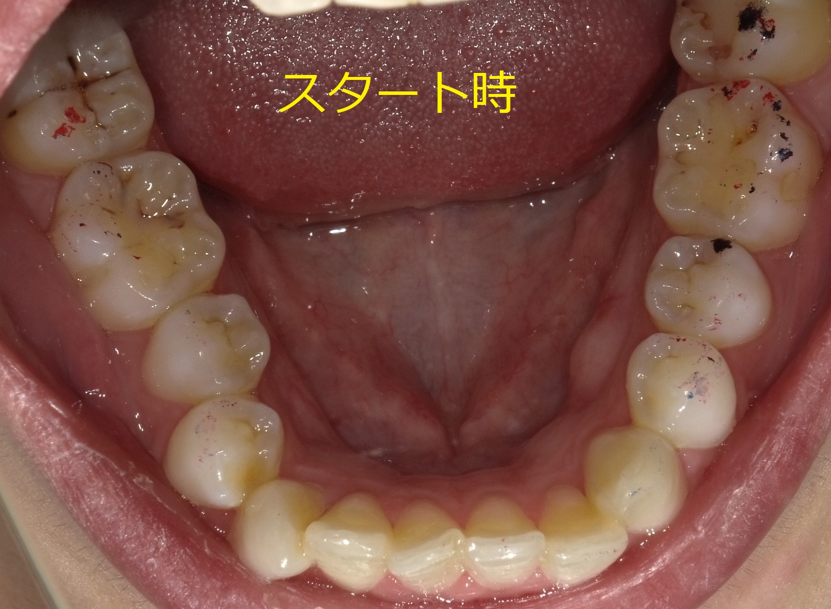 インビザラインによる上下部分矯正　①