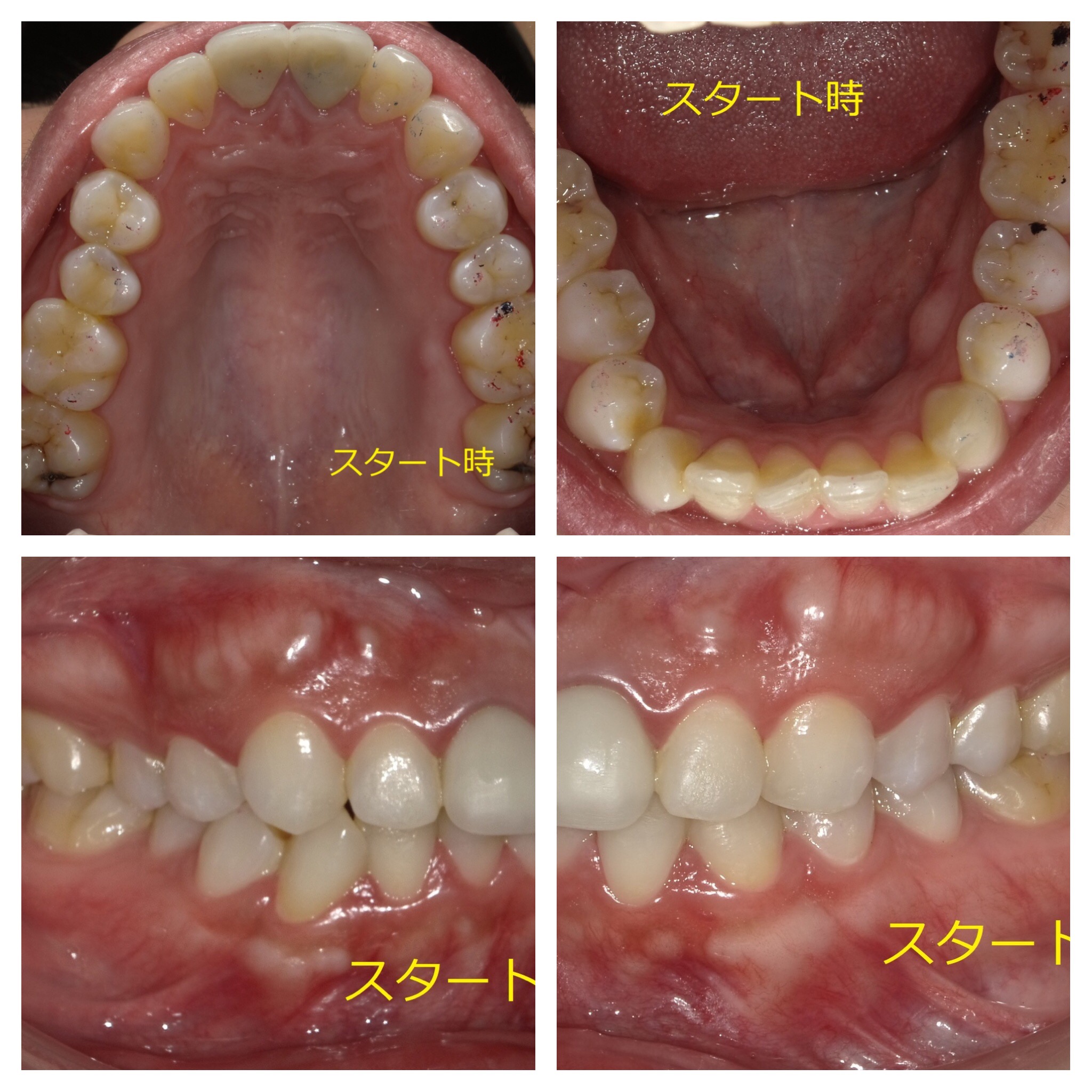 インビザラインによる上下部分矯正　①