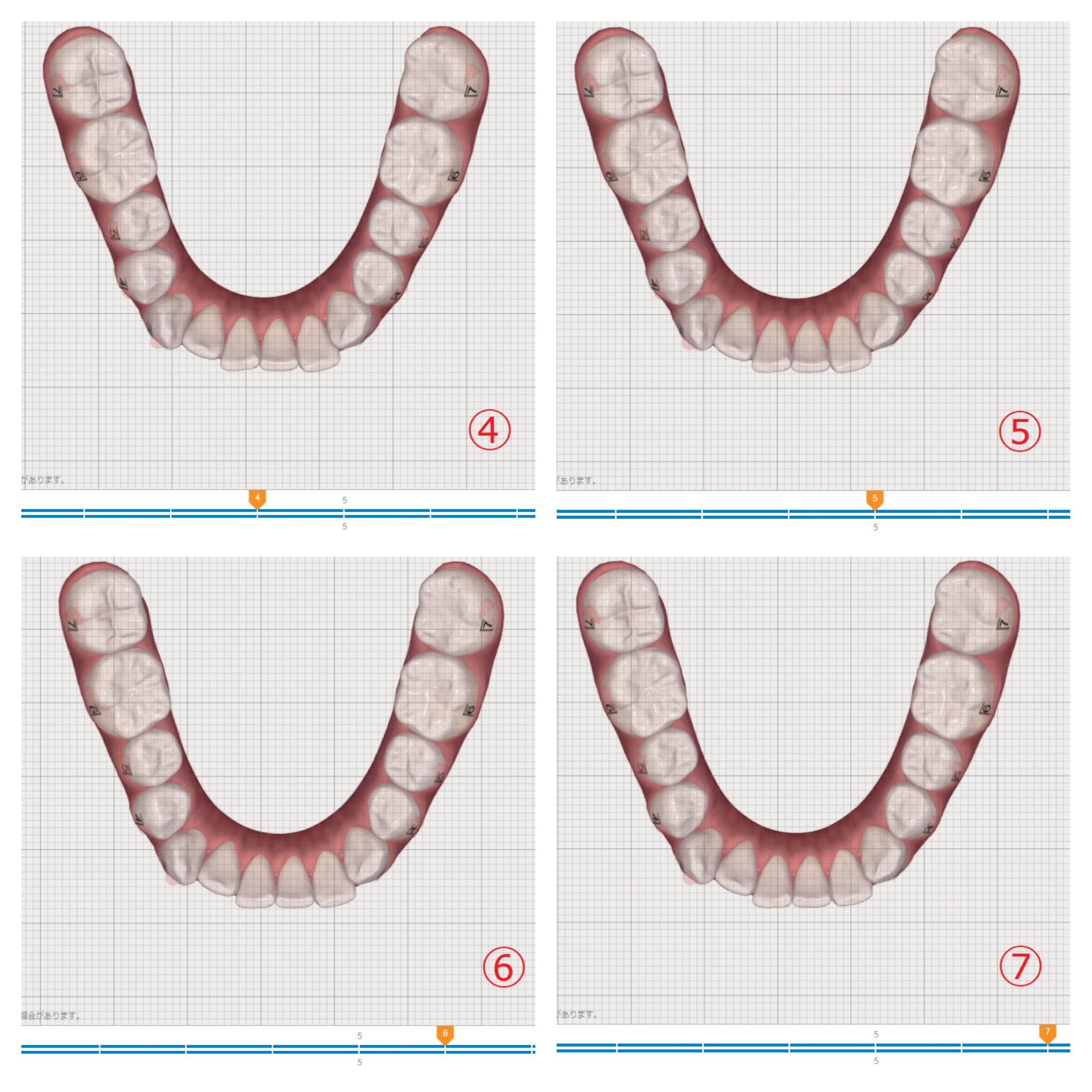 インビザラインによる上下部分矯正　⑥