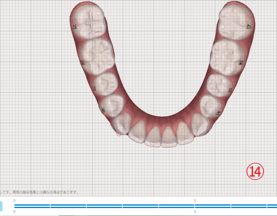 インビザラインによる上下部分矯正　⑦