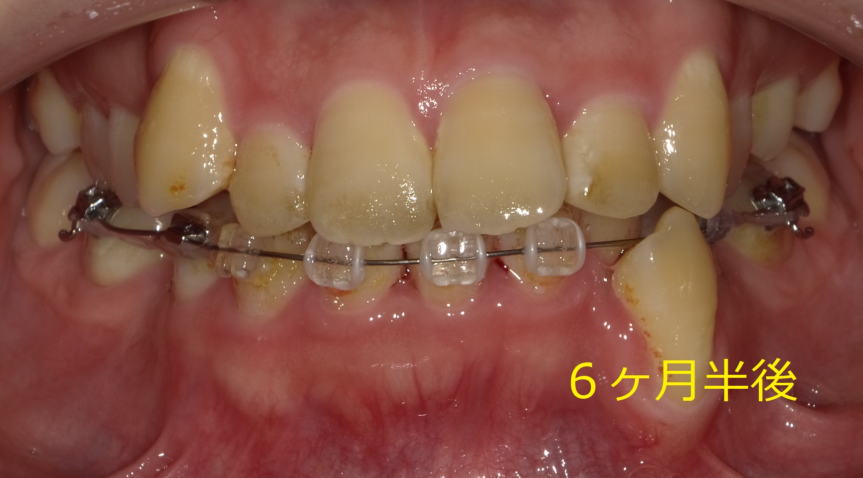 乱ぐい歯　叢生がキツイ症例。　⑨