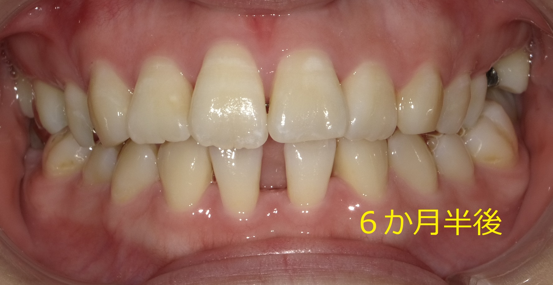 上顎のみ＋欠損スペースを利用しての矯正　⑪
