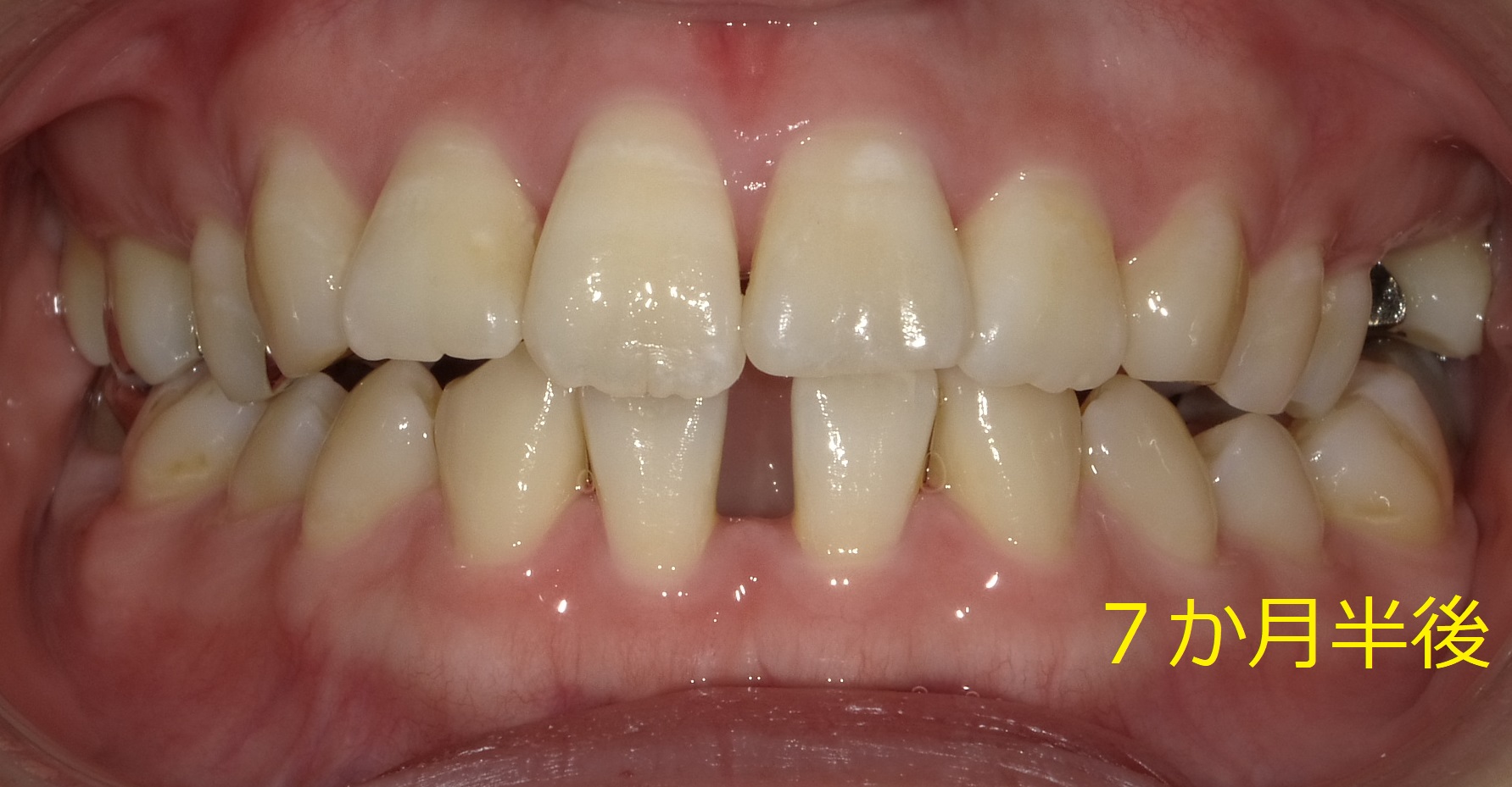 上顎のみ＋欠損スペースを利用しての矯正　⑫