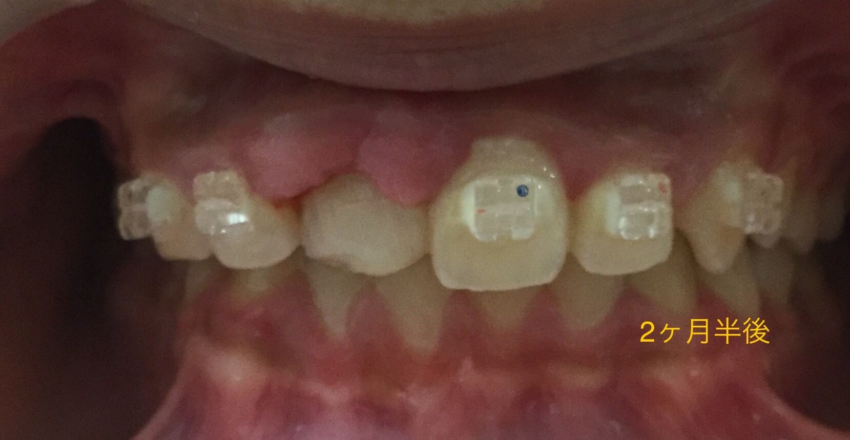 前歯が一本だけ入り込んだ症例（2ヶ月半後）